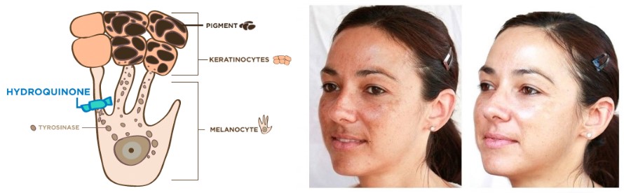 How Hydroquinone Works