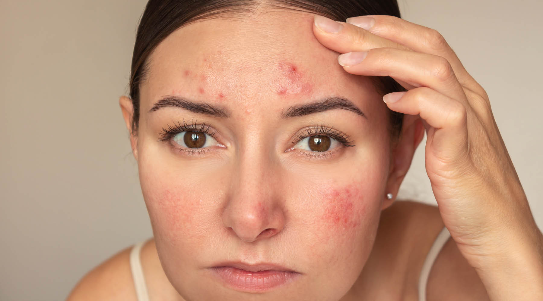 If Your Primary Concern Is Breakouts and Acne