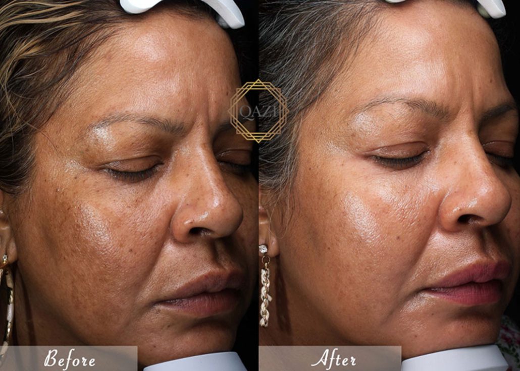 Is hydroquinone safe for short-term use on dark skin?