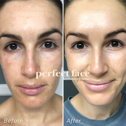 Retinol and Retinoids