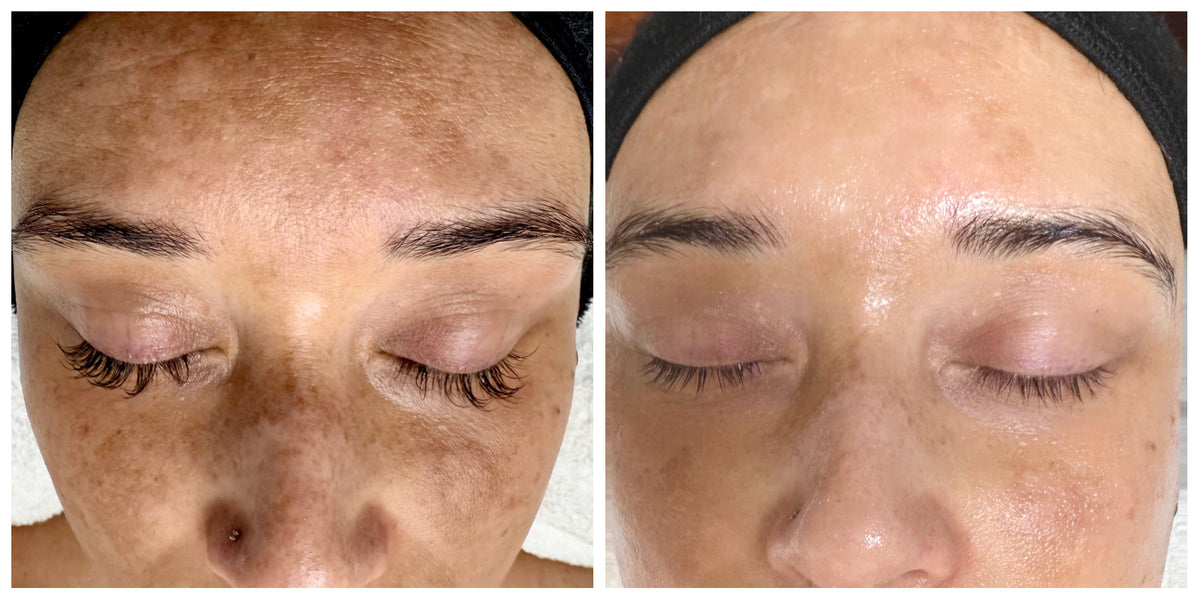 Risk of Worsening Hyperpigmentation