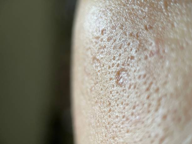 Sebum Distribution