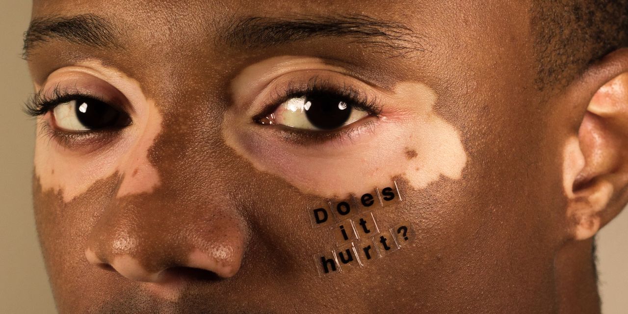 The Verdict for Melanin Skin