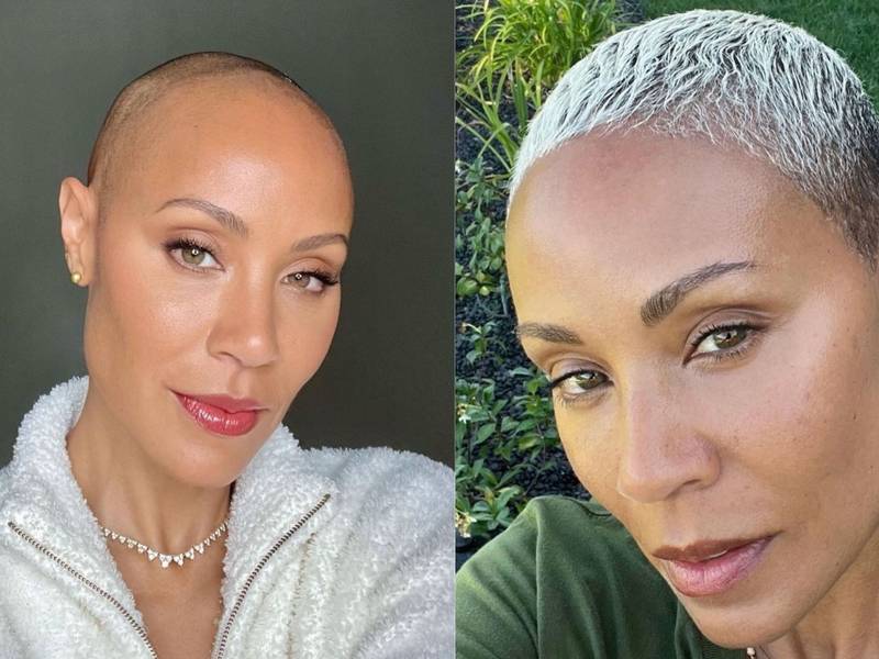 On Body Image and the Alopecia Journey