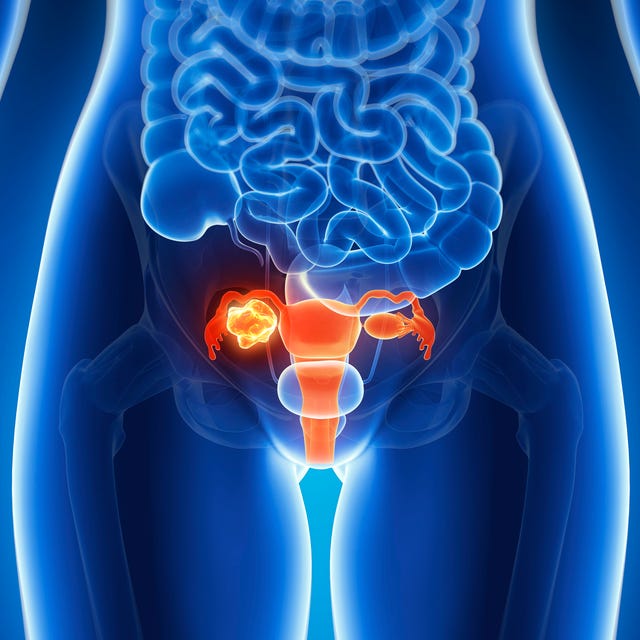 Why Ovarian Cancer Is So Hard to Catch Early