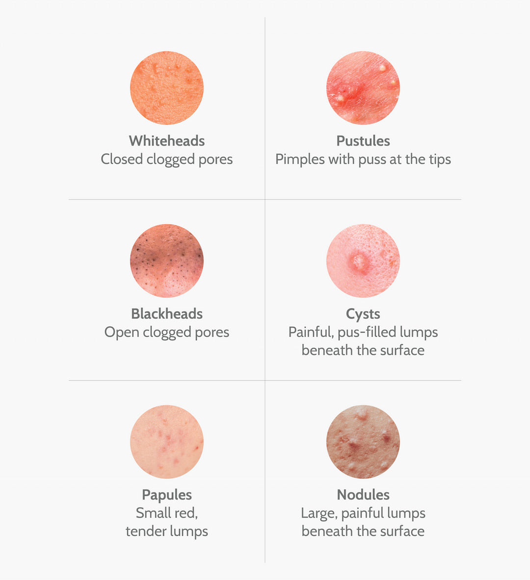 Recurring Adult Acne That Tracks With the Gut